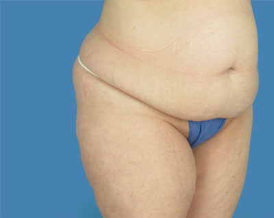 LipoTuck Before & After Patient #1031