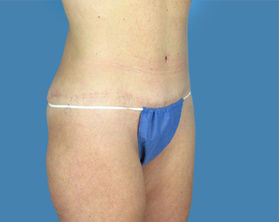 LipoTuck Before & After Patient #1031