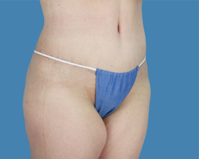 LipoTuck Before & After Patient #1032