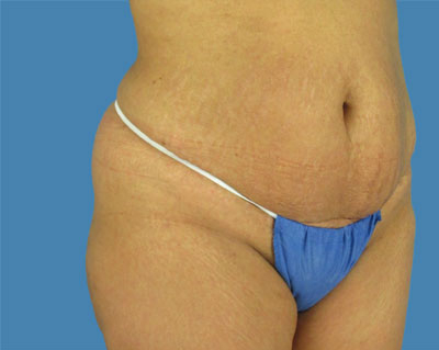 LipoTuck Before & After Patient #1033