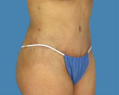 LipoTuck Before & After Patient #1033