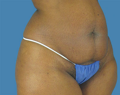 LipoTuck Before & After Patient #1048