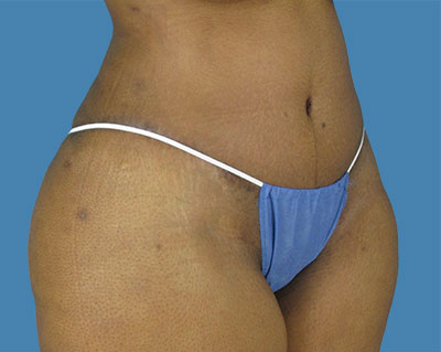 LipoTuck Before & After Patient #1048