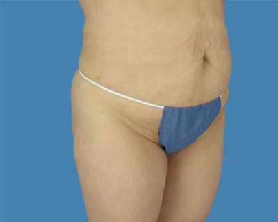 LipoTuck Before & After Patient #1034