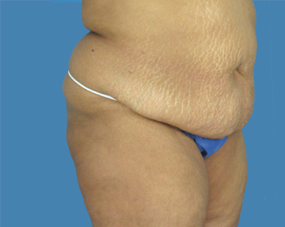 LipoTuck Before & After Patient #1037