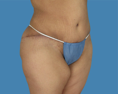 Lipotuck Before & After Patient #1038