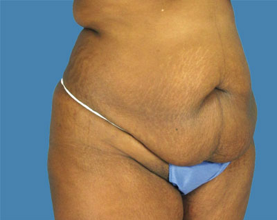 LipoTuck Before & After Patient #1039