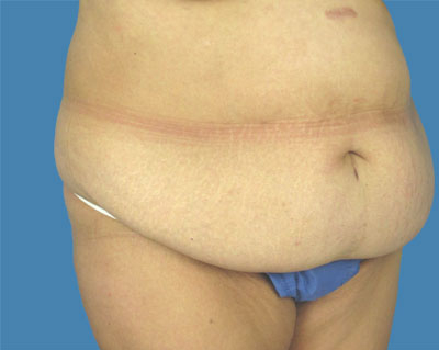 LipoTuck Before & After Patient #1040