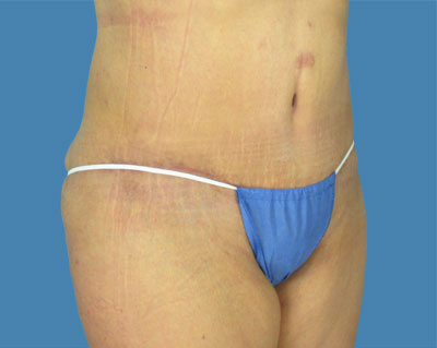 LipoTuck Before & After Patient #1040