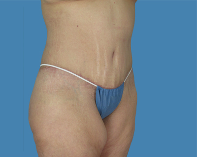LipoTuck Before & After Patient #1041