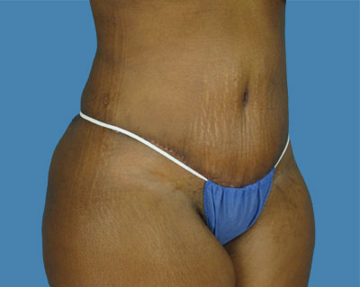 LipoTuck Before & After Patient #1042
