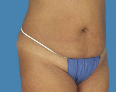 LipoTuck Before & After Patient #1043
