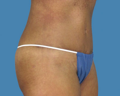 LipoTuck Before & After Patient #1043