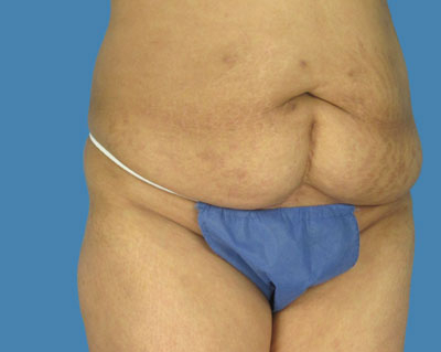 LipoTuck Before & After Patient #1044