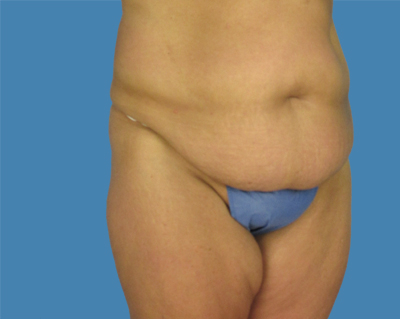 LipoTuck Before & After Patient #1045