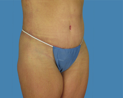 LipoTuck Before & After Patient #1045