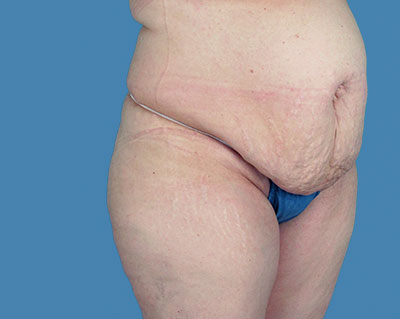 LipoTuck Before & After Patient #1061