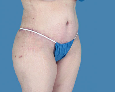 LipoTuck Before & After Patient #1061