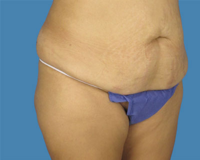 LipoTuck Before & After Patient #1046