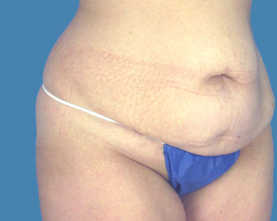 LipoTuck Before & After Patient #1052
