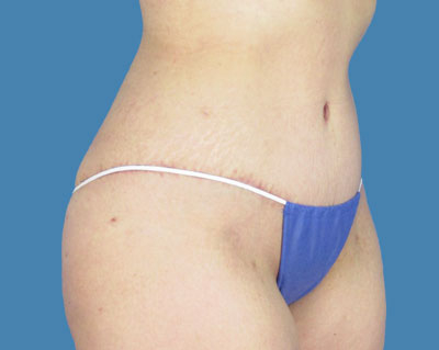 LipoTuck Before & After Patient #1052