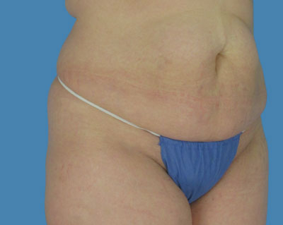 LipoTuck Before & After Patient #1054