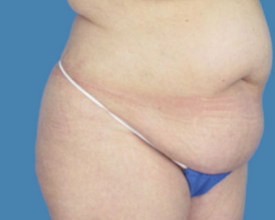 LipoTuck Before & After Patient #1056