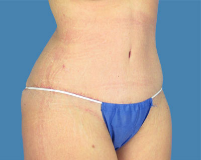 Lipotuck Before & After Patient #1058