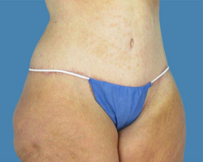 LipoTuck Before & After Patient #1060
