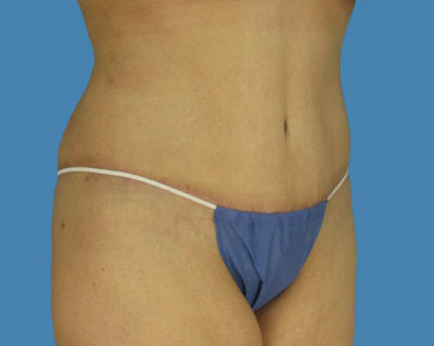 Lipotuck Before & After Patient #1063