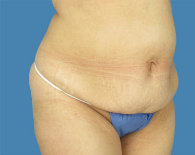 LipoTuck Before & After Patient #1064