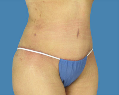 LipoTuck Before & After Patient #1064