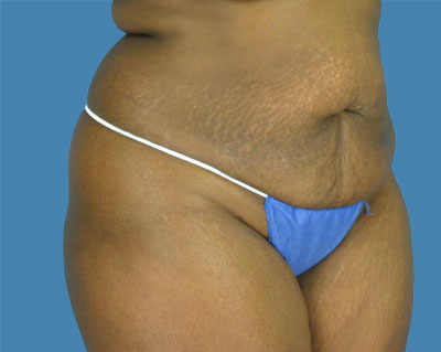 LipoTuck Before & After Patient #1065