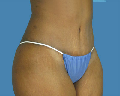 LipoTuck Before & After Patient #1065