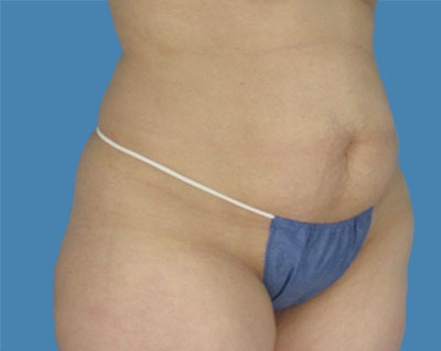 LipoTuck Before & After Patient #1066