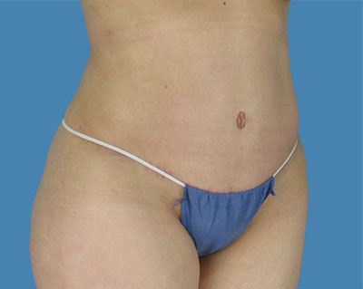 LipoTuck Before & After Patient #1066