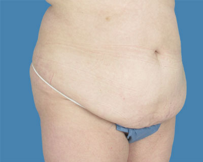 LipoTuck Before & After Patient #942