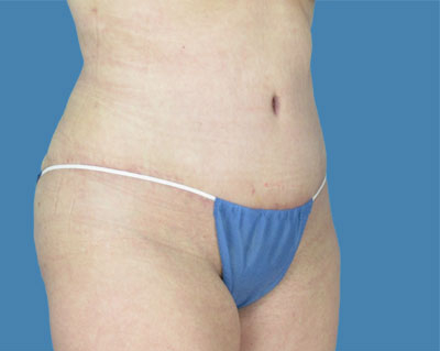 LipoTuck Before & After Patient #942