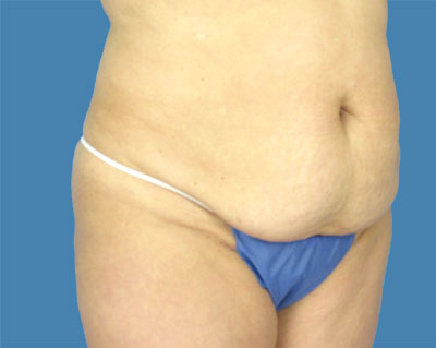 LipoTuck Before & After Patient #944