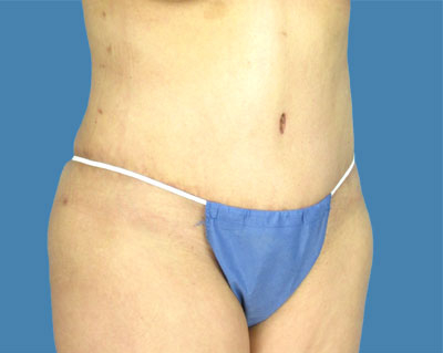 LipoTuck Before & After Patient #944