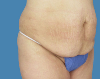 LipoTuck Before & After Patient #979