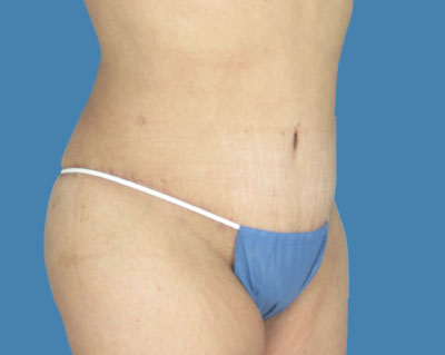 LipoTuck Before & After Patient #979