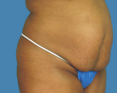 LipoTuck Before & After Patient #977