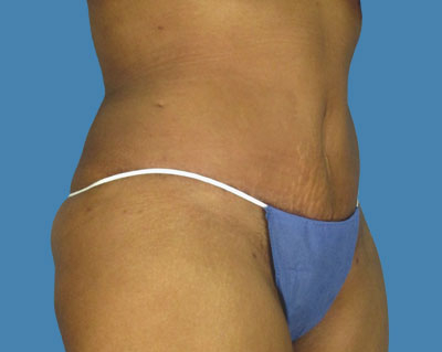 LipoTuck Before & After Patient #977