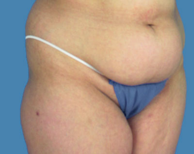 LipoTuck Before & After Patient #976
