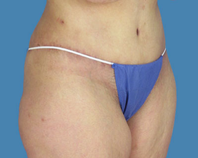 LipoTuck Before & After Patient #976