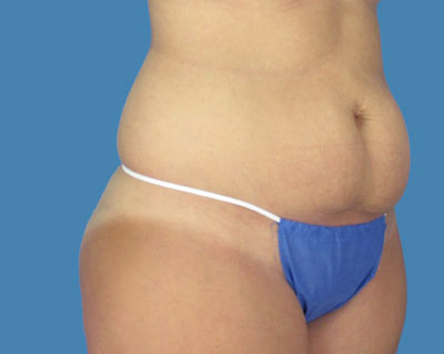 Lipotuck Before & After Patient #982