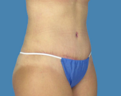 Lipotuck Before & After Patient #982