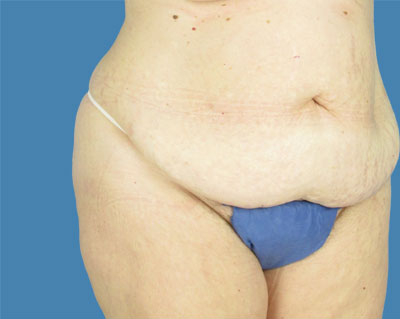 LipoTuck Before & After Patient #974
