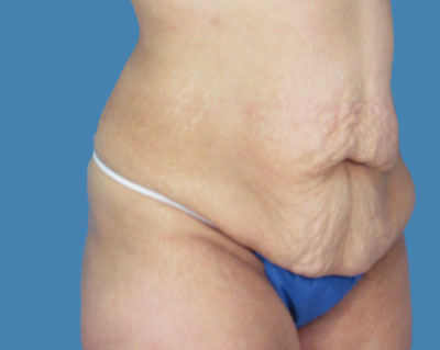 LipoTuck Before & After Patient #984